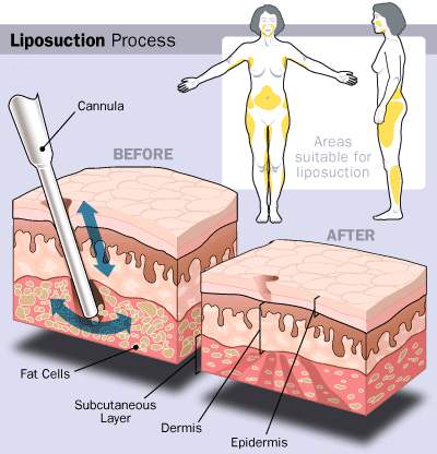 Liposuction Process