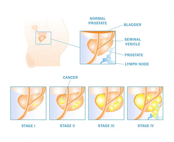 Prostate Cancer Staging
