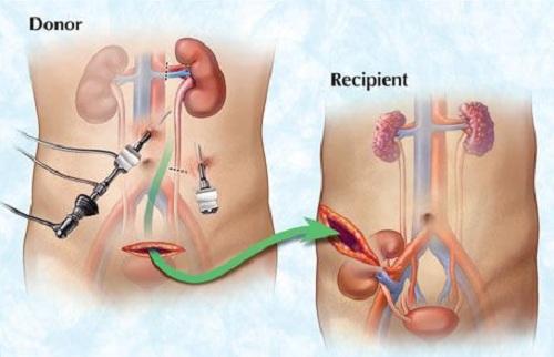 living kidney donation living kidney donation