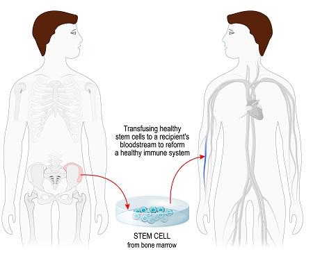 Procedure of BMT