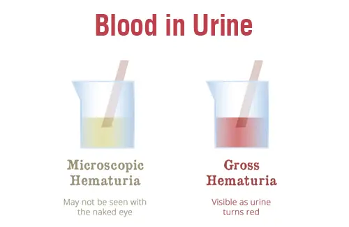 types of hematuria types of hematuria
