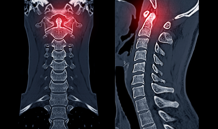 What is done in spine surgery