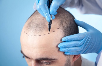 Get your hair transplant done by Dr Anil Behl 