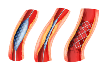 Stents used in Angioplasty