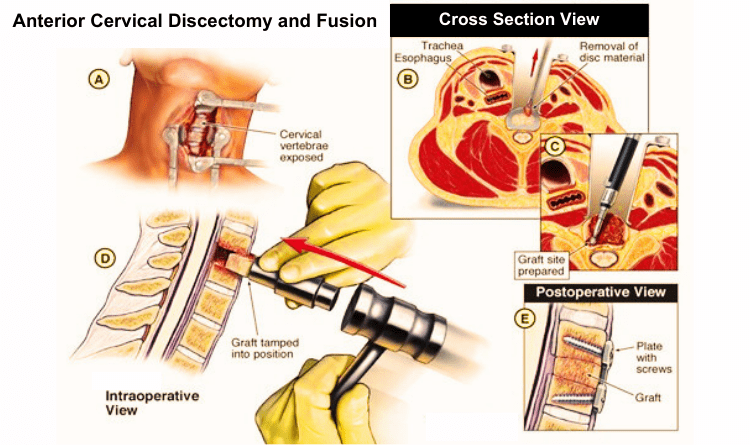 anterior cervical discectomy process