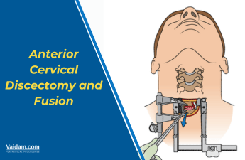 Anterior Cervical Discectomy and Fusion Surgery: Preparation and Recovery