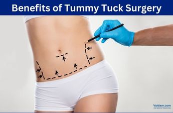 How a Tummy Tuck Beneficial for Your Overall Health?