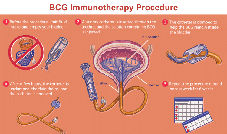 bcg immunotherapy