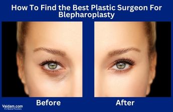 How To Find the Best Plastic Surgeon For Blepharoplasty