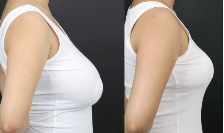 breast reduction health benefits