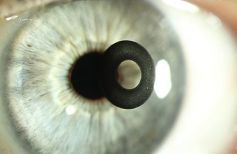 Cataract treatment in India