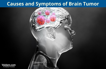 Causes and Symptoms of Brain Tumor