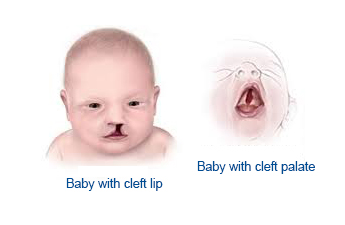 complications of cleft lip and cleft palate
