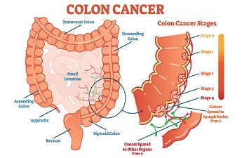 Be Aware of the Colon Cancer Symptoms and its Treatment by Colo-Rectal Surgeon Dr. Matthew Tytherleigh