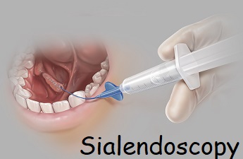 Sialendoscopie: Introduction, indications et technique