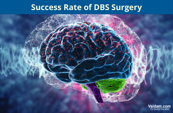 What is the Success Rate of DBS Surgery?
