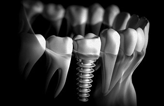 Имплантация зубов в Индии