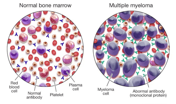 multiple myeloma