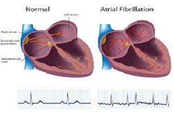 A Guide to Atrial Fibrillation and Cardiac surgeon Dr. Devananda’s Expertise in this