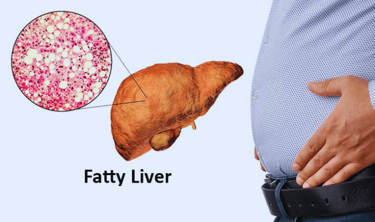 fatty liver intro image