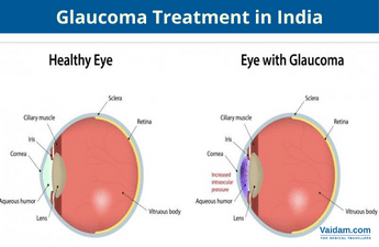 Glaucoma Treatment in India