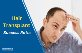 How Successful Are Hair Transplants?
