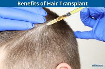 Hair transplant benefits