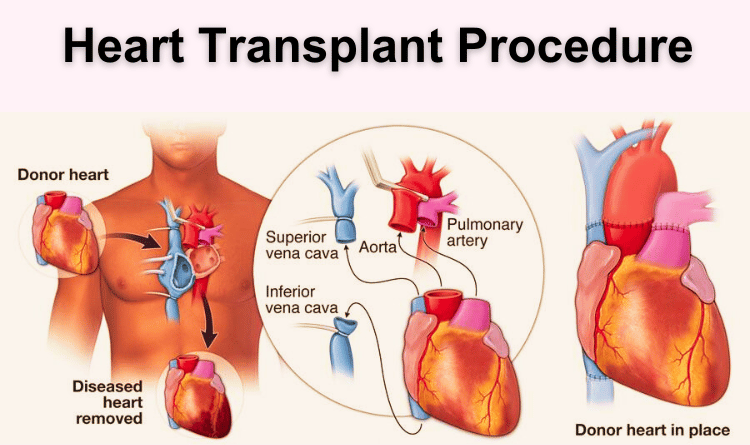 heart transplant procedure