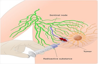 Sentinel Node Biopsy Helps in Determining Cancer By General Surgeon Dr. Millicent Alache Bello 