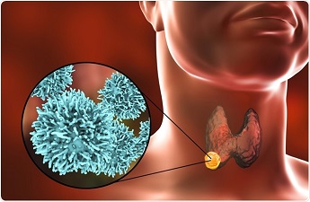 Symptoms that can lead to Thyroid Cancer and its Treatment by Endocrinologist Dr. Job Simon