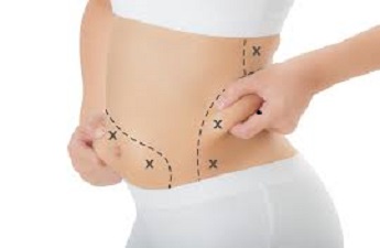 Improve your Body Shape with Tummy Tuck Surgery by Aesthetics and Plastic Surgeon Dr. Frank Conroy