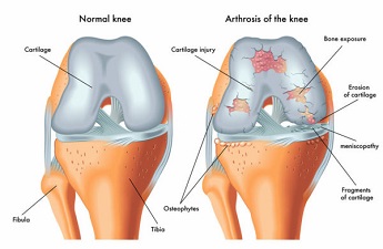 Orthopaedic and Joint Replacement Surgeon Dr. Vivek Mahajan’s Way of Treating Arthritis Through Cartilage Repair