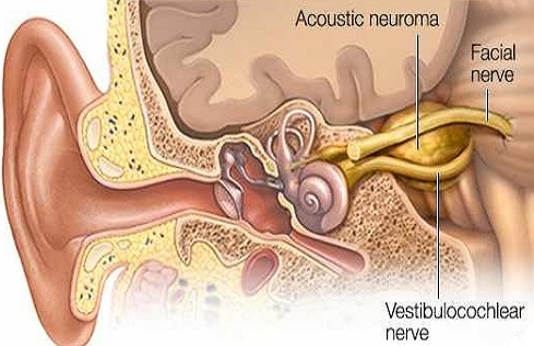 akustik nöroma