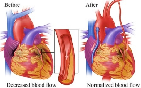 coronary artery bypass surgery