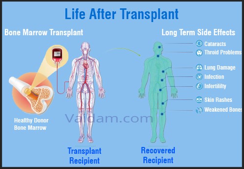 Success rate of bone marrow transplant