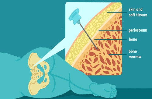 how bone marrow transplant works