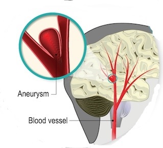 Brain Aneurysm 