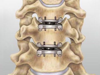 Cervical Disk Replacement Surgery 