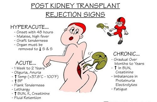 kidney transplant in Turky