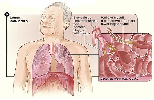 appearance of lungs with COPD