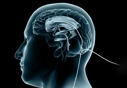 Deep Brain Stimulation Surgery