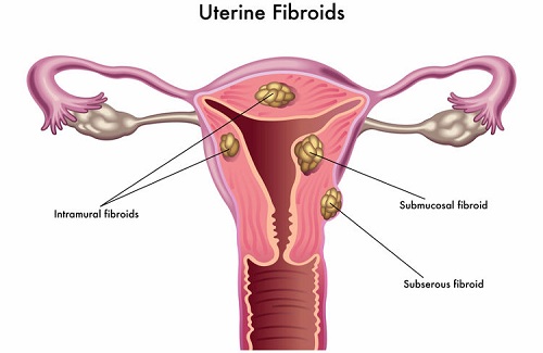 uterus miomasining turlari