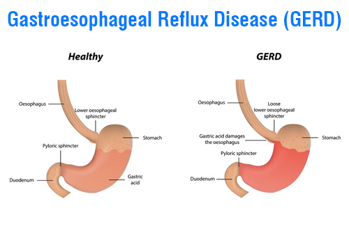 Gastroesophageal Reflux Disease (GERD)- A brief duscussion about it