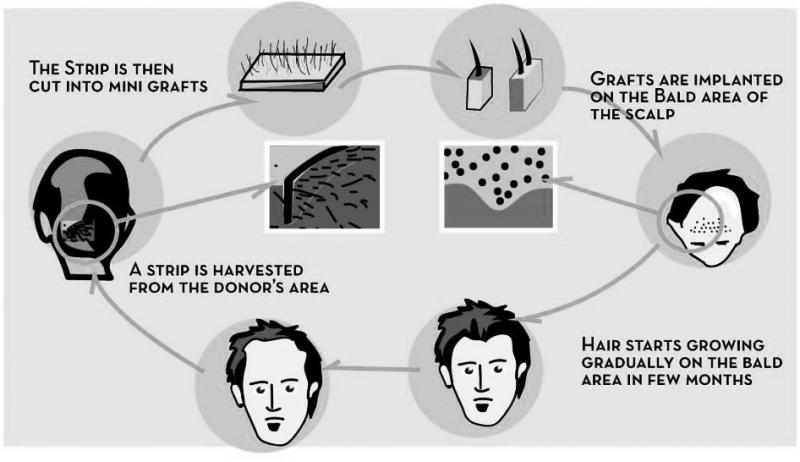 Answers To Frequently Asked Questions About Hair Transplant | Vaidam Health
