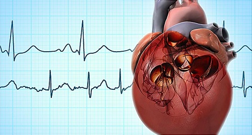 The most common complication of heart surgery in India