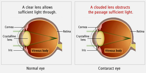 How Cataract Develops