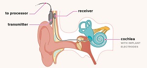 Cochlear Implant Surgery 