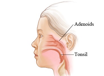 Adenoid and tonsil