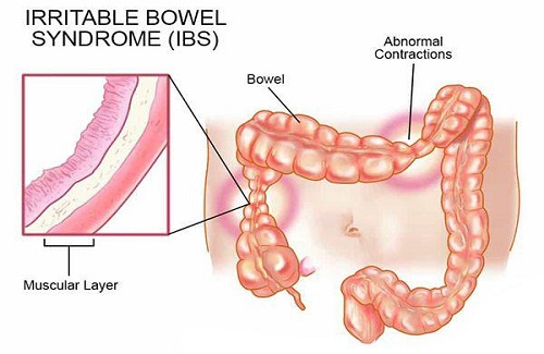 Irritation Bowel Syndrome