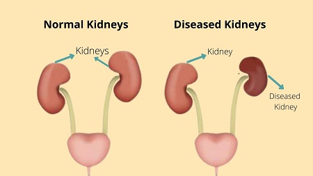 Kidney related disease